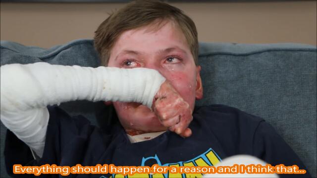 Living in a Body of Open Wounds with Less than Half His Skin (Epidermolysis Bullosa)