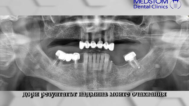 Поставяне на Зъбни импланти от Implantmedstom