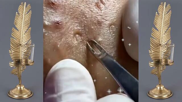 Best Vevo Blackheads removal | Vevo dr Acne Treatment |acne by Vevo.dr acne 004