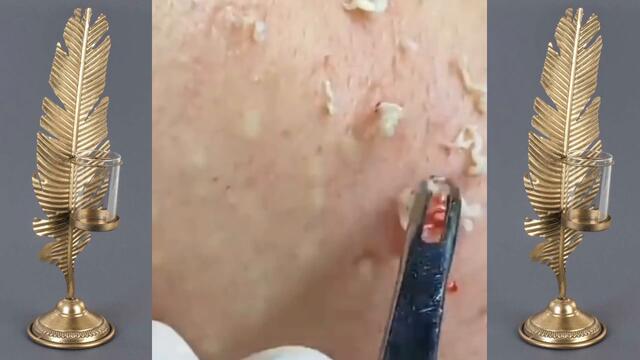 Best Vevo Blackheads removal | Vevo dr Acne Treatment |pimple popping | acne by Vevo.dr acne 022
