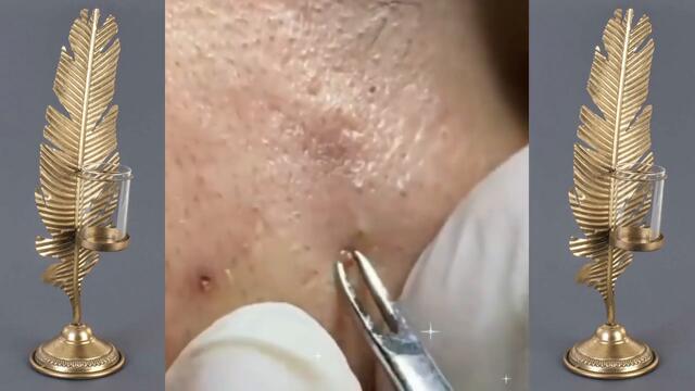 Best Vevo Blackheads removal | Vevo dr Acne Treatment |pimple popping | acne by Vevo.dr acne 012