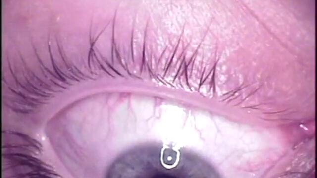 Full Length Lasik Surgery